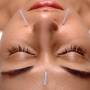 Acupunctuur